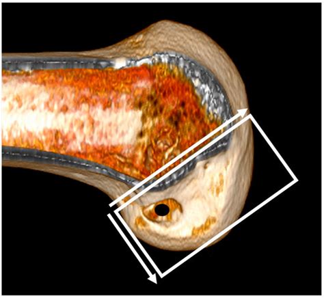 Medicina Free Full Text Femoral Tunnel Geometry And Graft