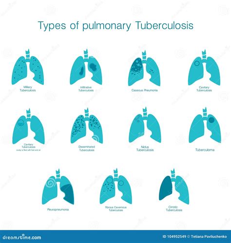 Types Of Tuberculosis Vector Silhouette Medical Illustration Of Human