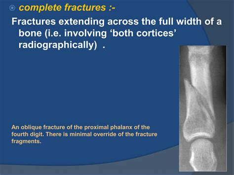 bone trauma common fractures long bone.ppt