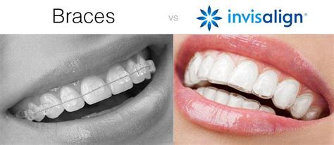 Advantages Of Invisalign David H Lee Dds Msd Board Certified