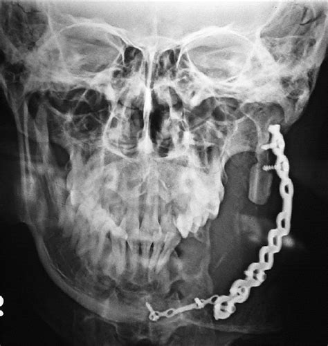 Orthopantomograph Showing The Reconstruction Plate Repairing The Defect