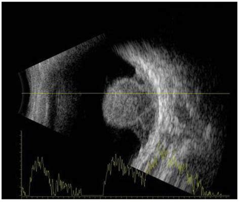Melanoma Ultrasound at Jason Lyon blog