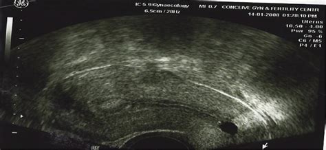 Endometrial Polyp Seen By A Vaginal Ultrasound Scan Conceive Ivf Hospital