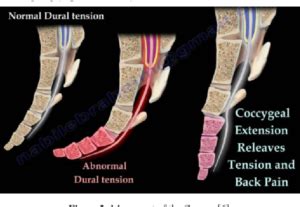 Coccydynia Treatment - Physiotherapy Victoria BC