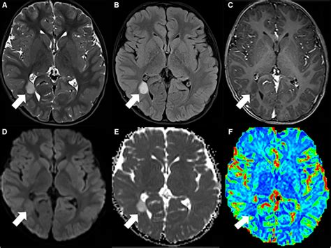 Pediatric Type Diffuse Low Grade Glioma A T2wi And B Flair Download Scientific Diagram