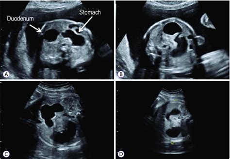 Duodenal Atresia Ultrasound