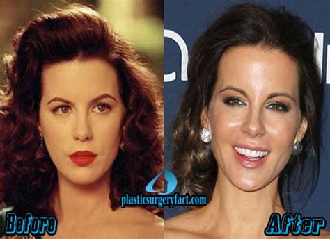 Kate Beckinsale Plastic Surgery Before and After