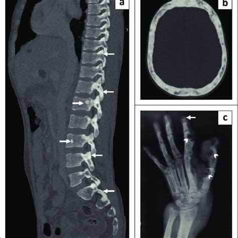 Guidelines For Imaging Surveillance Of Tuberous Sclerosis Complex