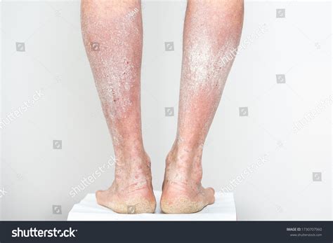 2,215 Psoriasis Legs Images, Stock Photos & Vectors | Shutterstock