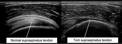 Cortisone And Steroid Shoulder Injections Ultrasound Guided Kingston