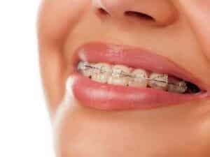 Different Types Of Braces Available And Which One To Choose