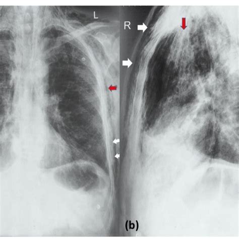 Elderly Man With Subcutaneous Emphysema Ginkgo Leaf Sign Request Pdf