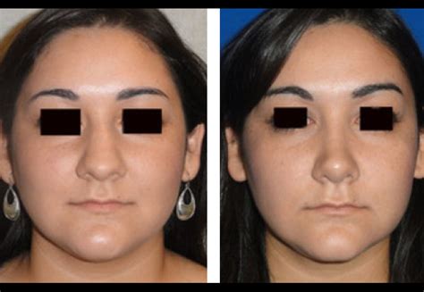 Revision Rhinoplasty Houston Texas Cilento Facial Plastics