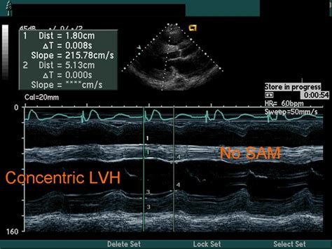 M Mode Echo Principles And Classic Findings Wikidoc