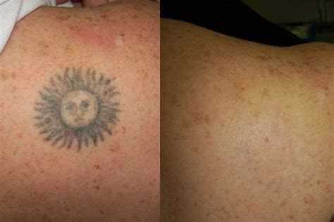 OUTattoo Eliminar Tatuajes Con Laser Cicatrices Y Manchas