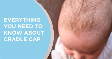 What Is Cradle Cap Causes And Steps To Deal With It At Home