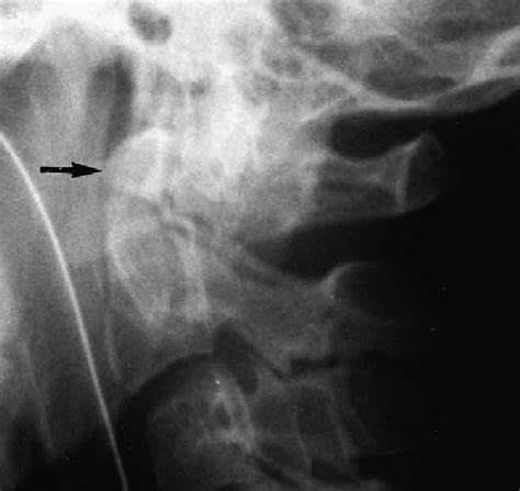 Radiograph Showing The Anterior Arch Of The Atlas In A Type Ii Fracture