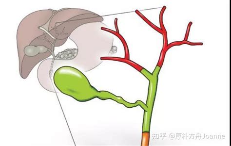 胆管癌患者如何选择治疗方式每种方式效果如何 知乎