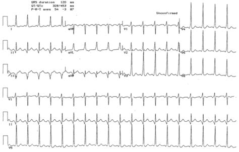 Diagnosis And Management Of Supraventricular Relias Media