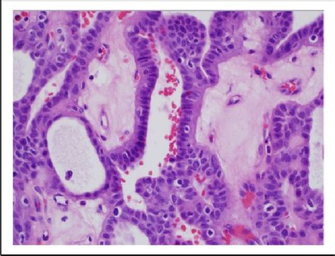 Figure 1 From Cribriform Morular Variant Of Papillary Thyroid Carcinoma