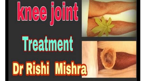 Knee Pain Treatment In Ayurveda Janu Basti And Physiotherapy By Dr