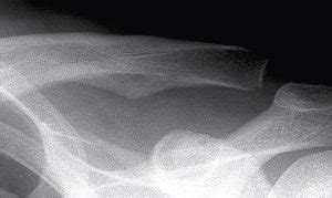 Acromioclavicular Joint Dislocation