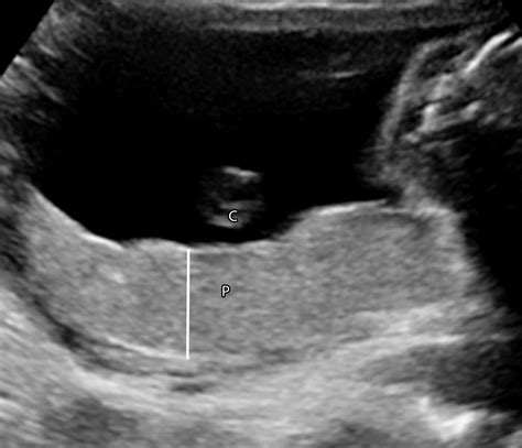 Placental Imaging Normal Appearance With Review Of Pathologic Findings