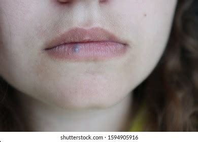 4,568 Lip Cancer Images, Stock Photos, and Vectors | Shutterstock