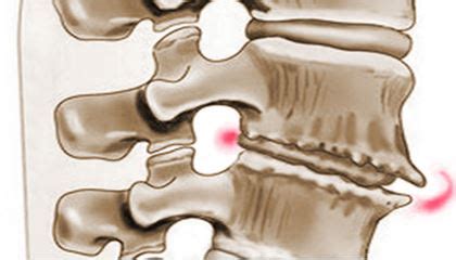 What does osteochondrosis look like, spinal osteochondrosis symptoms pictures, cervical ...