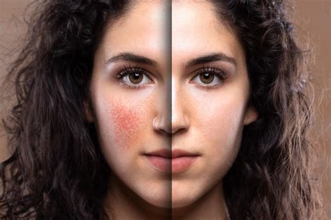 Understanding The Different Types Of Rosacea Medical Dermatology