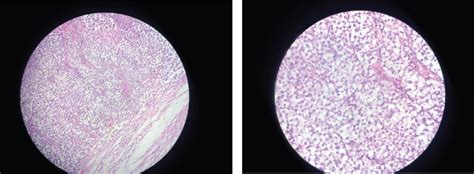 A Case Of Ruptured Intra Abdominal Germ Cell Tumor Seminoma Of