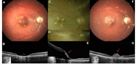 Preoperative Photo And Oct Scan Of Posttraumatic Large Mh In Case A