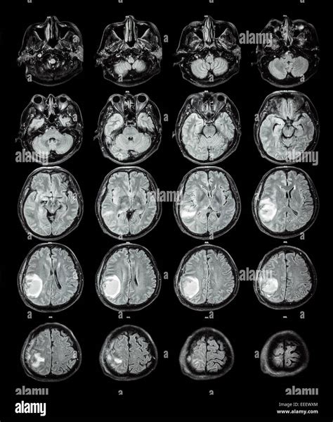 MRI brain : Brain tumor at right parietal lobe Stock Photo - Alamy