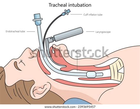 Tracheal Intubation Structure Diagram Hand Drawn Stock Illustration