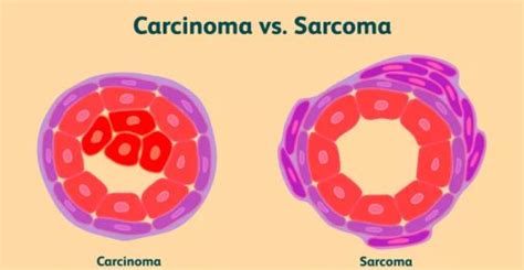 Carcinoma And Sarcoma The Difference I Kosheeka