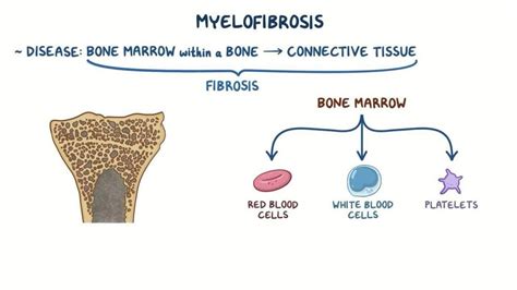 Myelofibrosis Penyebab Gejala Diagnosis Dan Pengobatan