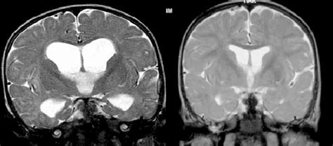 Noncommunicating hydrocephalus in a 8-months old girl (left... | Download Scientific Diagram