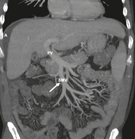 Coronal Contrast Enhanced Ct Image Showing Ectatic Supe Open I