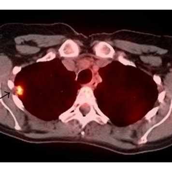 Ct Chest Showing Cm Cm Rul Pleural Based Nodule Arrow