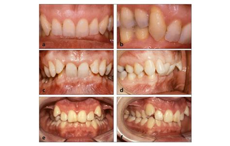 Class Ii Division Malocclusions Pocket Dentistry