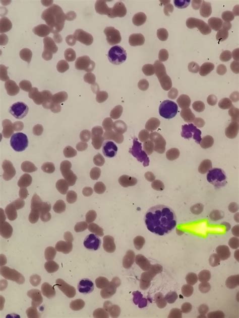 Impressive neutrophil hypersegmentation : r/Hematology