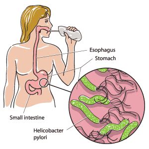 Helicobacter Pylori Urea Breath Test - MedBroadcast.com