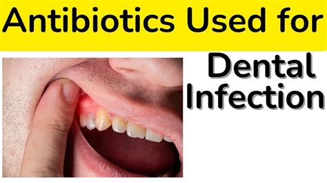 Top Antibiotics For Dental Infection Dant Dard Ho To Kon Antibiotics