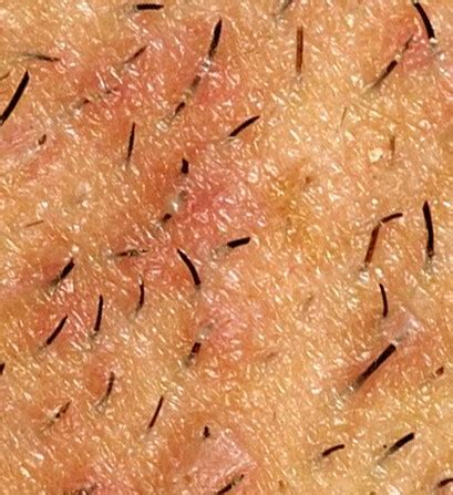 Infected Ingrown Hair - Symptoms, Treatment, Pictures, Removal, Causes