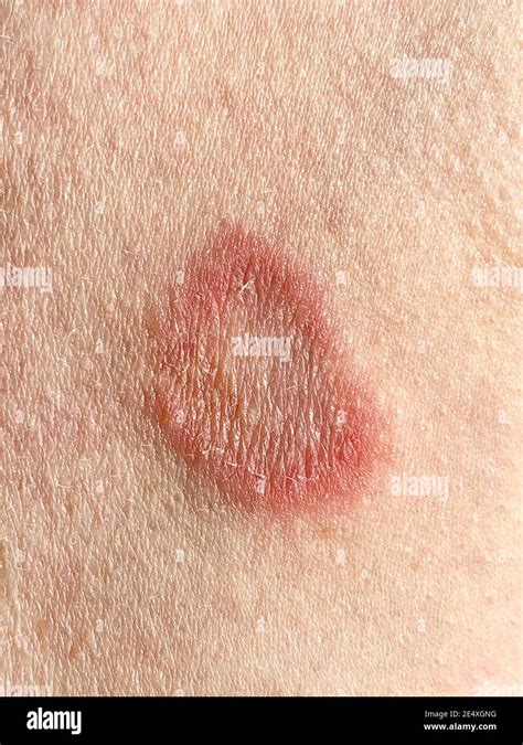 Causas De Dermatitis Atopica Fotograf As E Im Genes De Alta Resoluci N