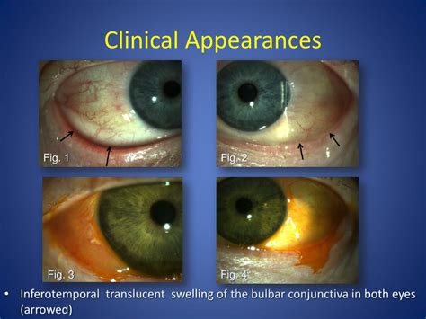 Ppt Conjunctival Lymphangiectasia Clinicopathological Features And Surgical Management