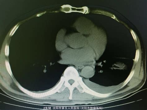 急性胰腺炎一例