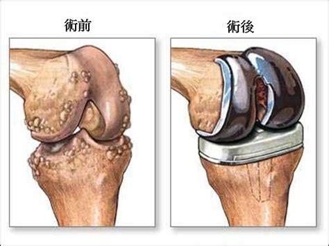 美接受人工膝關節置換術者日眾 大紀元