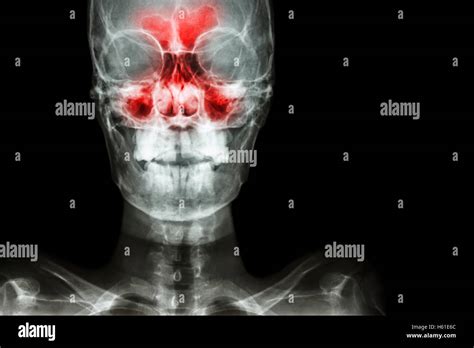 Coronary Sinus X Ray