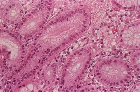 Stomach Metaplasia 1 By Cnriscience Photo Library